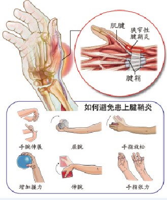 腱鞘炎结构图